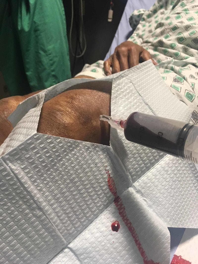 Clinical photograph depicting an arthrocentesis procedure being performed on a patient's knee. The image shows a large-bore syringe attached to a needle inserted into the suprapatellar region of the joint space. The syringe is partially filled with dark red, opaque aspirated fluid, which is visually consistent with hemarthrosis (blood within the joint). A sterile, textured gray drape surrounds the puncture site, with a small trail and droplet of sanguineous fluid visible on the drape, extending from the insertion point. The patient is positioned supine in a hospital setting, partially visible in a patterned gown. This procedural image demonstrates the diagnostic and therapeutic aspiration of a joint effusion, relevant for orthopedic and rheumatological education regarding the identification of hemarthrosis following joint trauma or coagulopathy.