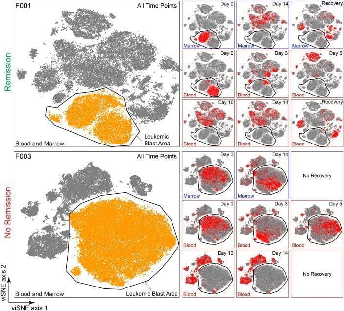 This infographic presents a 27-dimensional viSNE (visual t-distributed Stochastic Neighbor Embedding) analysis of mass cytometry data from two Acute Myeloid Leukemia (AML) patients, labeled F001 and F003, visualizing clinical response over time. The primary visualization for each patient includes a combined viSNE map of all live cells from all time points. A black outline demarcates the 'Leukemic Blast Area,' highlighted in orange, representing the phenotypic space occupied by malignant cells. Patient F001 is labeled 'Remission,' while Patient F003 is labeled 'No Remission.' To the right, series of longitudinal viSNE maps represent specific time points (Day 0, 3, 5, 10, 14, and Recovery) from both bone marrow and peripheral blood. In these temporal maps, cells from the specific time point are highlighted in red against a grey background of all historical cells. The visualization demonstrates educational concepts in hematology-oncology, specifically the clearance of malignant blasts in the remission patient (F001) versus the persistence of the leukemic population within the blast area in the non-remission patient (F003) across induction therapy.
