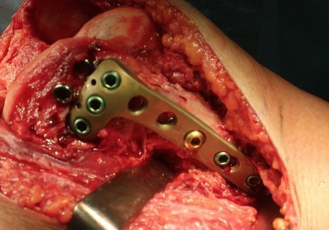 An intraoperative clinical photograph demonstrating an open reduction and internal fixation (ORIF) procedure for a distal femoral fracture. The image shows a locking compression plate (LCP) originally designed for the proximal tibia being utilized in an off-label, inverted orientation to provide anatomical fixation for the medial femoral condyle. The metallic plate is contoured to the bone surface and secured with a combination of cortical and locking screws. Key visible features include the exposed bone and soft tissue of the right knee joint through a medial parapatellar approach, with surgical retractors reflecting the tissue. The educational focus of this image is on unconventional hardware application and surgical salvage techniques for complex intra-articular fractures (AO classification: 33-B2.1). This material is relevant for orthopedic surgery residents and trauma surgeons specializing in lower limb reconstruction.