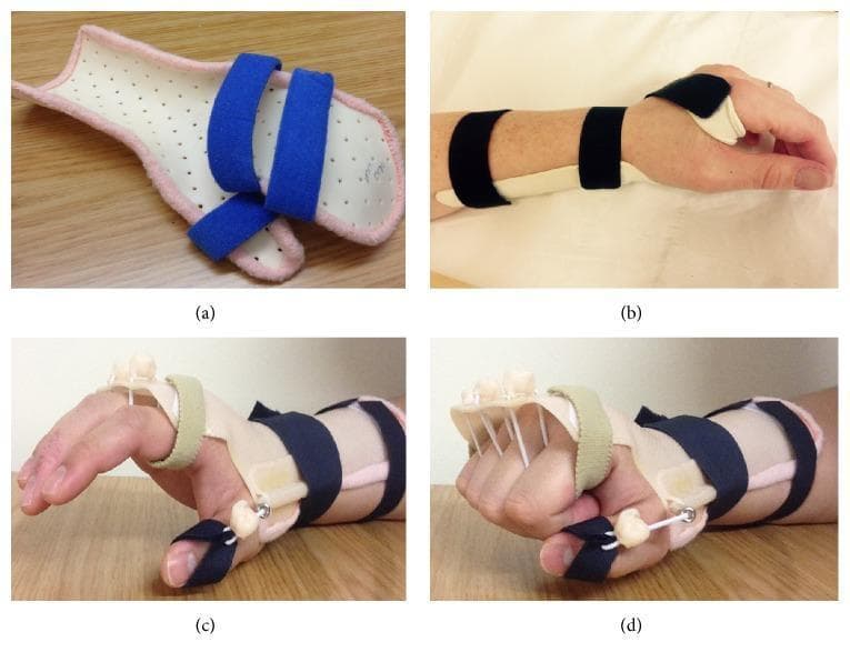 A composite clinical photograph showcasing various orthotic devices utilized in the management of radial nerve palsy. (a) A static resting hand splint composed of a white perforated thermoplastic base with a pink padded liner and blue hook-and-loop straps, designed to maintain the hand and wrist in a functional neutral position. (b) A volar wrist-extension splint applied to a patient, featuring a dorsal hand strap to prevent wrist drop. (c) and (d) demonstrate a dynamic extension orthosis in use. This complex device utilizes a dorsal thermoplastic forearm shell and a series of elastic outriggers or tension wires attached to finger slings. The mechanism provides passive assisted extension of the metacarpophalangeal (MCP) joints and thumb, compensating for the loss of extensor muscle function characteristic of radial nerve injury, while allowing for active finger flexion. These orthoses are critical in hand therapy to prevent contractures, maintain joint mobility, and improve functional grasp during nerve recovery.