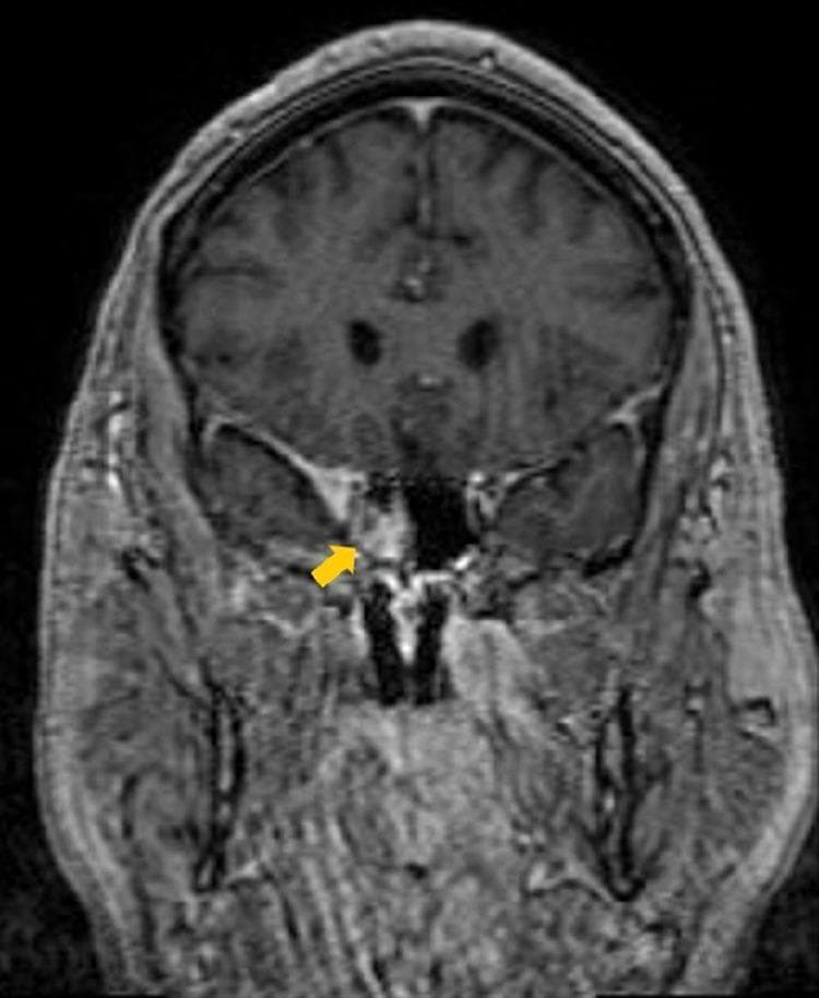 This diagnostic image is a coronal contrast-enhanced T1-weighted MRI of the brain and skull base. The primary finding is a focal area of increased signal intensity (hyperintensity) indicating abnormal contrast enhancement within the right cavernous sinus. A yellow arrow points specifically to the lateral margin of this enhancement where it extends anteriorly toward the right orbital apex. In contrast, the contralateral left cavernous sinus appears normal. The surrounding neuroanatomical structures, including the pituitary gland, sphenoid sinus, and temporal lobes, are visible as anatomical landmarks. This imaging is clinically significant for evaluating inflammatory or neoplastic processes of the cavernous sinus, such as Tolosa-Hunt syndrome or cavernous sinus thrombosis, as it demonstrates localized inflammation or tissue infiltration extending toward the orbital apex.
