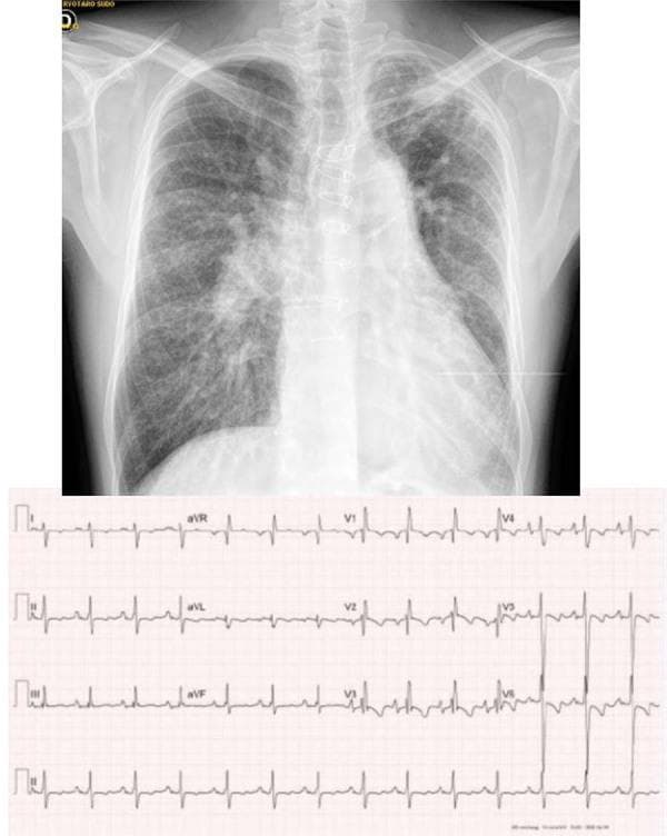 Educational composite containing a posteroanterior chest X-ray and a 12-lead electrocardiogram (ECG) demonstrating complex congenital heart disease. The chest radiograph shows cardiomegaly with a prominent left ventricular contour and a bulging middle arch. A striking pulmonary vascular asymmetry is visible: the right lung shows increased hilar vascularity with peripheral tapering suggestive of pulmonary arterial hypertension, while the left lung exhibits significantly reduced vascular markings with thin, sparse vessels indicating pulmonary hypoperfusion. Below, the 12-lead ECG shows sinus rhythm with right axis deviation (+110 degrees) and signs of right cavity overload, including apiculate P waves (P-pulmonale) and a predominant S-wave pattern in leads V4-V6. Diffuse T-wave inversions are present in the precordial leads, reflecting generalized ventricular repolarization changes. This combination is clinically relevant for evaluating complex cyanotic heart defects, such as double outlet right ventricle with asymmetric pulmonary flow or pulmonary atresia.