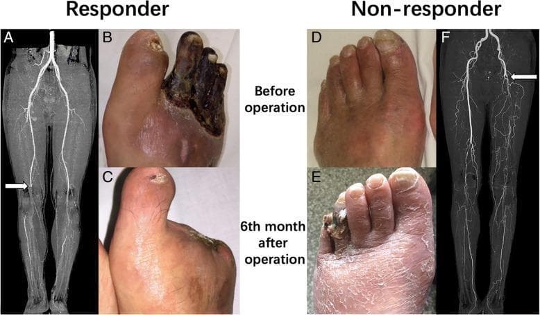 A multi-panel clinical composite comparing treatment outcomes in critical limb ischemia (CLI) between a 'Responder' and a 'Non-responder' using diagnostic imaging and clinical photographs. The Responder case (left) illustrates thromboangiitis obliterans (Buerger's disease). Preoperative CTA (A) shows an arterial occlusion at the popliteal artery level (white arrow). The corresponding clinical photo (B) displays advanced dry gangrene of the second, third, and fourth toes. At 6 months post-operation (C), the foot shows complete wound healing following debridement and cell transplantation. The Non-responder case (right) illustrates atherosclerosis obliterans. Preoperative CTA (F) reveals a proximal superficial femoral artery occlusion (white arrow). Initial clinical photography (D) shows only mild cyanosis and skin changes. However, 6 months post-treatment (E), the condition has progressed to distal gangrene of the lateral toes with diffuse desquamation and xerosis of the dorsal foot skin. This comparison highlights the prognostic variability in CLI based on etiology (TAO vs. ASO) and arterial occlusion level, serving as an educational tool for evaluating peripheral vascular disease progression and therapeutic response.