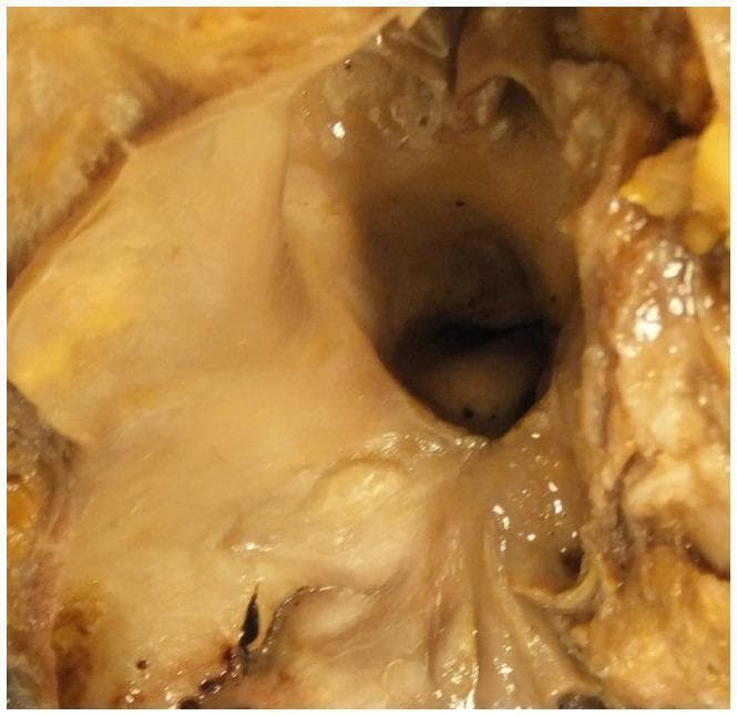 This clinical photograph displays a gross pathological specimen of an open pulmonary artery. The luminal surface of the vessel exhibits significant morphological alterations, characterized by multiple raised, yellowish intimal plaques consistent with atheroma. These features are a classic hallmark of chronic pulmonary hypertension, which in this clinical context is associated with Eisenmenger syndrome—a condition where long-standing left-to-right congenital heart shunts cause pulmonary vascular remodeling. The presence of atherosclerotic-like changes in the typically low-pressure pulmonary circuit indicates severe, prolonged elevation in pulmonary arterial pressure. The image serves as an educational tool for identifying macroscopic signs of vascular pathology in the setting of advanced congenital heart disease and pulmonary hypertensive vascular disease.