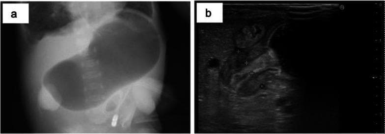 This composite diagnostic image illustrates classic findings of infantile hypertrophic pyloric stenosis (HPS) using two modalities. Image (a) is a supine abdominal X-ray (radiography) of an infant demonstrating a severely distended, air-filled stomach (the 'single bubble' appearance), occupying the majority of the upper abdomen and crossing the midline. This indicates gastric outlet obstruction. Image (b) is a transverse abdominal ultrasonography scan of the same patient. It shows a significantly thickened and elongated pyloric muscle, which appears as a hypoechoic (dark) ring surrounding a narrow central lumen. Caliper markers on the ultrasound indicate a muscle wall thickness of 4-5 mm, exceeding the standard diagnostic threshold (typically >3 mm). The combination of these images serves as a primary diagnostic tool for HPS, demonstrating both the secondary effect (gastric dilation) and the primary pathology (pyloric muscular hypertrophy).
