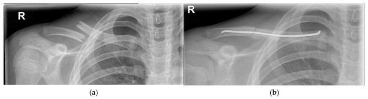 This comparative diagnostic image consists of two anteroposterior radiographs of the right shoulder and clavicle. Image (a) depicts a complete midshaft (Group I/Allman Type 1) clavicle fracture with extreme displacement and significant shortening. The distal fragment is positioned superiorly and posteriorly relative to the proximal fragment, with no evidence of primary bone callus formation. Image (b) shows the same clavicle following surgical intervention for internal fixation. A radiopaque intramedullary wire is visible, spanning the fracture site through the medullary canal to restore anatomical alignment and stability. The wire extends from the medial aspect through the lateral portion of the clavicle. These images illustrate the radiological presentation of a severe clavicular fracture and its subsequent management via intramedullary nailing. The clinical significance highlights surgical indications for highly displaced pediatric or adult clavicle fractures where conservative management may be insufficient for functional recovery.