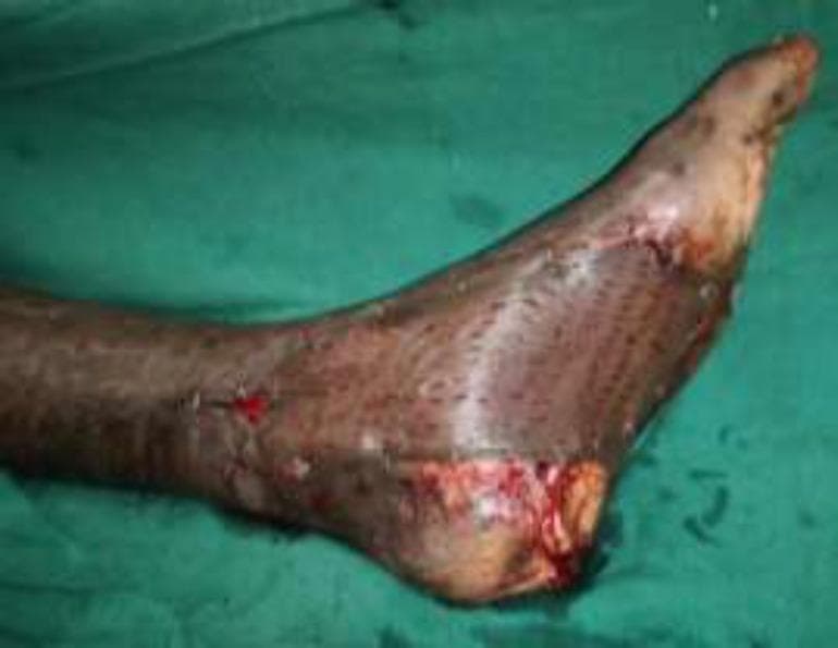 A clinical photograph of the medial aspect of a human foot and ankle showing a post-operative reconstruction for a diabetic foot ulcer. The image demonstrates a large muscular flap covered by a meshed split-thickness skin graft (STSG). The graft exhibits a characteristic reticulated or 'honeycomb' pattern with small, diamond-shaped interstitial spaces designed to allow for graft expansion and fluid drainage. Surgical sutures are visible at the margins where the flap is integrated with the surrounding host skin. There is evidence of normal immediate post-operative inflammation, including localized erythema and minor serosanguinous exudate at the wound edges. This visual represents a complex reconstructive procedure, likely involving a free muscle flap (such as a gracilis muscle) to provide bulk and vascularity to a weight-bearing or joint-adjacent area, followed by meshed STSG for epithelial coverage.