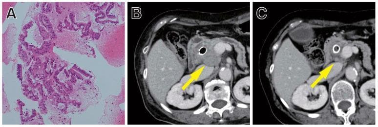 A multi-panel medical image illustrating the clinical response of microsatellite instability-high (MSI-H) pancreatic cancer to immunotherapy. Panel A is a histopathological micrograph (H&E stain) of a pancreatic tissue sample obtained via EUS-FNB, showing irregular, hyperchromatic glandular structures characteristic of adenocarcinoma. Panels B and C are axial contrast-enhanced CT scans of the abdomen at the level of the pancreas. Scan B depicts a baseline state with a large, ill-defined, heterogeneous mass in the head of the pancreas (indicated by a yellow arrow) that was refractory to prior chemotherapy. Scan C shows the same anatomical region 8 weeks into pembrolizumab therapy, demonstrating a significant reduction in the size and density of the pancreatic head mass (indicated by a yellow arrow), representing a partial clinical response. The image serves to demonstrate the utility of biomarker testing (MSI-H) in tailoring immunotherapy for pancreatic ductal adenocarcinoma.