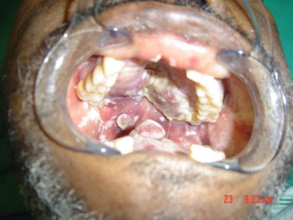 This clinical photograph provides an intraoral view of a patient with advanced AIDS-related Kaposi sarcoma (KS). The image demonstrates extensive, multifocal lesions involving the hard palate, soft palate, and the dorsum of the tongue. The lesions appear as large, exophytic, purple-red nodules and lobulated masses with irregular surfaces. In addition to the vascular neoplastic lesions, the oral mucosa shows signs of secondary complications, including patchy white plaques suggestive of oral candidiasis. The surrounding gingival tissues are erythematous and swollen. Notable dental findings include significant brownish staining and plaque accumulation on the maxillary teeth, likely reflecting poor oral hygiene secondary to the pain and mechanical obstruction caused by the large intraoral masses. This image serves as a classic illustration of the severe oral manifestations of Human Herpesvirus 8 (HHV-8) infection in the context of profound immunosuppression, highlighting the clinical presentation of nodular KS which can interfere with speech, mastication, and swallowing.