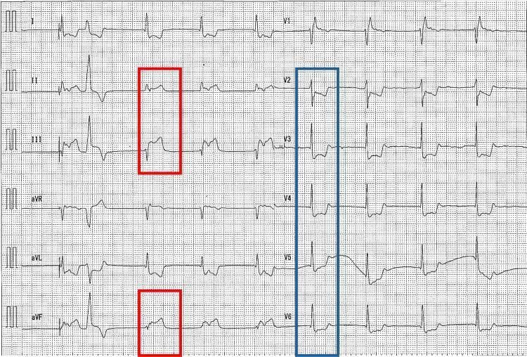 This diagnostic image is a 12-lead electrocardiogram (ECG) demonstrating an acute inferior myocardial infarction. The tracing shows marked ST-segment elevation in the inferior leads (II, III, and aVF), highlighted by red rectangular annotations. Concurrently, reciprocal ST-segment depression is visible in the precordial leads (V2 through V6), indicated by a blue rectangular annotation. The rhythm appears to be a sinus rhythm with a prolonged PR interval, suggestive of a first-degree atrioventricular block, and there is evident bradycardia. The ECG morphology is characteristic of an evolving ST-elevation myocardial infarction (STEMI) involving the inferior wall, often associated with right coronary artery occlusion. This visual material is intended for medical students and clinicians to learn the identification of ischemic patterns, specifically inferior wall injury and the importance of recognizing reciprocal changes in the anterior and lateral leads.
