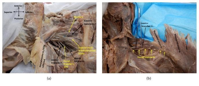 Two high-resolution cadaveric dissection photographs demonstrating the anatomical course and innervation of the dorsal scapular nerve (DSN). Image (a) presents an anterolateral view of the right neck in a supine position. Key structures identified include the phrenic nerve, anterior and middle scalene muscles, and the superior trunk of the brachial plexus. The DSN is labeled originating from the C4 root and is shown piercing the middle scalene muscle. Image (b) shows a posterior view in the prone position with the rhomboid major and minor muscles reflected laterally. This view clearly illustrates the posteroinferior trajectory of the DSN as it supplies the levator scapulae, rhomboid minor, and rhomboid major muscles. The dissections highlight the variability in nerve origin and its critical relationship to the scalene musculature and the posterior scapular muscle group. This material is designed for advanced anatomical study, specifically focusing on peripheral nerve pathways and surgical landmarks in the neck and upper back.