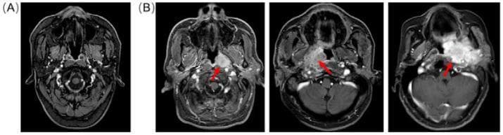 Axial contrast-enhanced T1-weighted Magnetic Resonance Imaging (MRI) comparison of a normal nasopharynx versus nasopharyngeal carcinoma (NPC). Image (A) displays a normal control featuring symmetrical anatomical structures, including the fossa of Rosenmüller, parapharyngeal space, and clear boundaries of the skull base. Image set (B) contains three scans from different patients showing a progression of NPC severity. Red arrows indicate hyperintense, contrast-enhancing masses within the nasopharynx. The pathological findings demonstrate varying degrees of tumor size, irregular margins, and structural distortion. In more advanced stages, the imaging reveals significant asymmetry, obliteration of the parapharyngeal fat planes, and invasion into adjacent soft tissues and intracranial regions. These images serve as a diagnostic reference for identifying NPC extension, perineural spread, and the characteristic loss of tissue differentiation associated with malignant nasopharyngeal lesions.