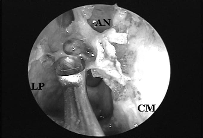 This procedural clinical photograph displays an endoscopic view of the right nasal cavity during a functional endoscopic sinus surgery (FESS). The image was captured using a 4mm 45-degree rigid endoscope. Key anatomical landmarks are labeled: the lamina papyracea (LP) on the lateral wall, the middle turbinate (CM) medially, and the agger nasi cell (AN) superiorly. The agger nasi cell is positioned such that it obstructs the direct endonasal visualization of the frontal sinus ostium, demonstrating a common anatomical variant that complicates frontal recess access. A surgical instrument is visible in the foreground, positioned near the lamina papyracea, indicating active manipulation for dissection or clearance of the obstructive ethmoidal cells. This image serves as an educational tool for identifying paranasal sinus anatomy and understanding the surgical challenges posed by agger nasi pneumatization in managing frontal sinus drainage.