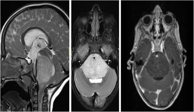 This diagnostic image set consists of three brain MRI scans illustrating a Diffuse Intrinsic Pontine Glioma (DIPG) in a 3.5-year-old female. The left panel shows a sagittal T2-weighted MRI, demonstrating a significantly enlarged pons with an expansive, hyperintense (bright) mass occupying the majority of the brainstem, characteristic of an infiltrative glioma. The middle panel is an axial T2-weighted MRI, highlighting the diffuse nature of the tumor as it encompasses more than 50% of the axial cross-section and ventrally engulfs the basilar artery (visible as a small dark flow void). The right panel shows an axial T1-weighted contrast-enhanced MRI, where the tumor appears predominantly hypointense with only very mild, focal, or linear contrast enhancement, indicating the absence of significant blood-brain barrier breakdown. Clinical relevance includes the diagnosis of DIPG based on typical radiographic features: diffuse expansion of the pons, T2-hyperintensity, and minimal contrast enhancement in a pediatric patient presenting with cranial neuropathies and motor decline.