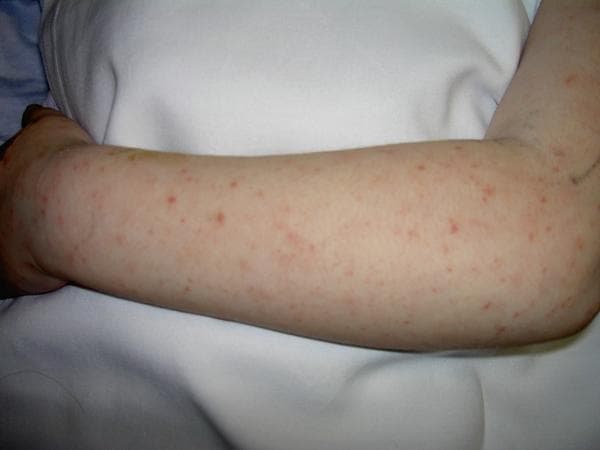 This clinical photograph displays the upper extremity of a patient, focusing on the ventral surface of the forearm and the dorsal aspect of the hand. The skin demonstrates an extensive, widespread eruption consisting of small, discrete, erythematous lesions. These lesions are primarily characterized as blanching macules and non-blanching petechiae, approximately 1-3 mm in diameter. The distribution is relatively uniform across the limb, with some areas showing higher density or mild clustering. This type of petechial and macular rash is a significant clinical finding in various systemic conditions, including infectious vasculitides such as Rocky Mountain Spotted Fever (RMSF), meningococcemia, or other febrile illnesses associated with thrombocytopenia. The image serves as a teaching tool for recognizing non-confluent exanthems and differentiating between inflammatory macular rashes and hemorrhagic petechial lesions in an acute clinical setting.