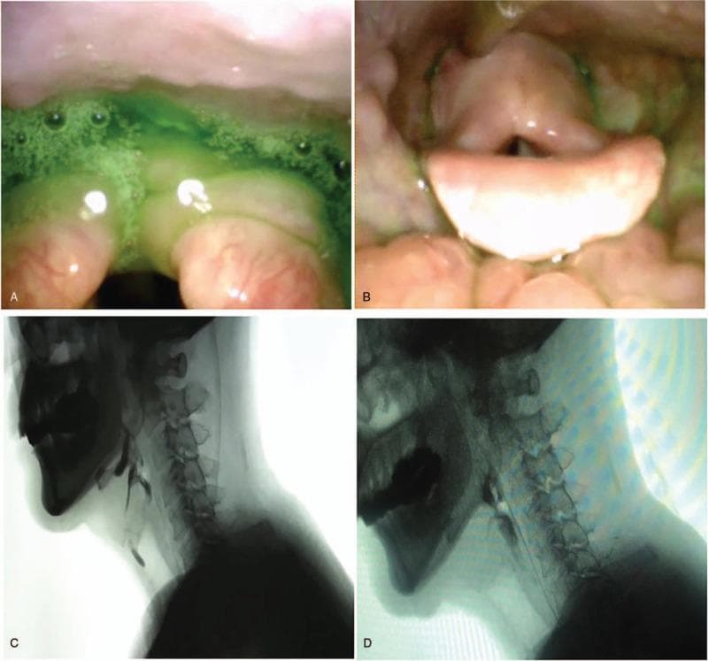 This composite figure illustrates a comparative evaluation of oropharyngeal dysphagia before and after treatment for cricopharyngeal (CP) muscle dysfunction. Panels A and B are Fiberoptic Endoscopic Evaluation of Swallowing (FEES) stills. Panel A (Pre-treatment) shows massive green-dyed mucilage secretions and pooling in the postcricoid region, indicating penetration and impaired clearance. Panel B (Post-treatment) shows a significant reduction in pharyngeal residue and clearer visualization of the laryngeal inlet. Panels C and D are lateral Video Fluoroscopic Swallowing Study (VFSS) frames. Panel C (Pre-treatment) demonstrates limited epiglottic folding and a persistent posterior indentation at the level of the CP muscle, signifying non-relaxation during a swallow attempt. Panel D (Post-treatment) reveals improved CP muscle opening, successful bolus passage through the upper esophageal sphincter, and decreased residue in the vallecula and pyriform sinuses. The images collectively demonstrate the therapeutic efficacy of botulinum toxin injection in improving upper esophageal sphincter dynamics and reducing aspiration risk in patients with neurogenic dysphagia.