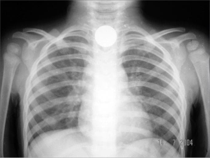 A frontal (anteroposterior) pediatric chest radiograph demonstrating an impacted foreign body. A highly radiopaque, circular, well-defined object, approximately 1.9 cm in diameter and consistent with a coin, is located centrally in the upper mediastinum at the level of the thoracic inlet. The coronal orientation of the coin on this AP view is characteristic of an esophageal location, specifically at the cricopharyngeal area (the first physiological constriction of the esophagus). The surrounding skeletal structures, including the ribs, clavicles, and scapulae, appear intact with normal alignment and no signs of acute fracture. The pulmonary parenchyma is clear, and the cardiomediastinal silhouette is within normal limits for age. This diagnostic image illustrates a common pediatric emergency involving foreign body ingestion and highlights the radiographic features used to differentiate esophageal versus tracheal impaction based on the orientation of the object.