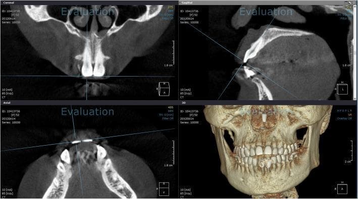 This diagnostic image displays a multi-planar reconstruction (MPR) of a maxillofacial cone beam computed tomography (CBCT) scan, categorized as Clinical Imaging for orthodontic or dental evaluation. The interface is divided into four panels: Coronal, Sagittal, Axial, and a 3D Volume Rendering. The Coronal view illustrates the maxilla, nasal septum, and inferior turbinates, with a horizontal reference line at the incisal edge. The Sagittal view shows a cross-section of a maxillary anterior tooth, with a blue software-generated line connecting the incisal edge to the root apex, facilitating tooth axis measurement. The Axial view provides a horizontal cross-section of the mandible and maxillary arch, showing the transverse relationship of the anterior dentition. The 3D reconstruction provides an external surface rendering of the skull, maxilla, and mandible, demonstrating full permanent dentition and occlusion. This setup is primarily used in dentistry for precise anatomical assessment, tooth inclination analysis, and pre-surgical planning by visualizing bone density and root morphology in relation to surrounding structures.