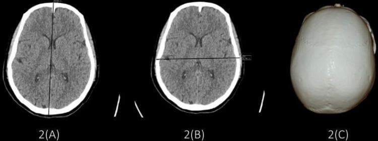 This composite diagnostic image illustrates the methodology for calculating the cephalic index using Computed Tomography (CT). Panels 2(A) and 2(B) show non-contrast axial CT scans of the head at the level of the lateral ventricles. Figure 2(A) demonstrates the measurement of the Maximum Cranial Length (MCL) via a mid-sagittal linear cursor extending from the glabella to the opisthocranion. Figure 2(B) illustrates the Maximum Cranial Breadth (MCB) measured as the maximum biparietal diameter perpendicular to the MCL. Visible neuroanatomical structures include the cerebral cortex, ventricles, and falx cerebri within the calvarium. Panel 2(C) presents a superior-view 3D volume-rendered reconstruction of the skull, highlighting its mesocephalic (ovoid) morphology and the sagittal suture. This image set is primarily used in radiology, forensic medicine, and physical anthropology to classify skull shapes (brachycephalic, dolichocephalic, or mesocephalic) based on the ratio of cranial breadth to length.