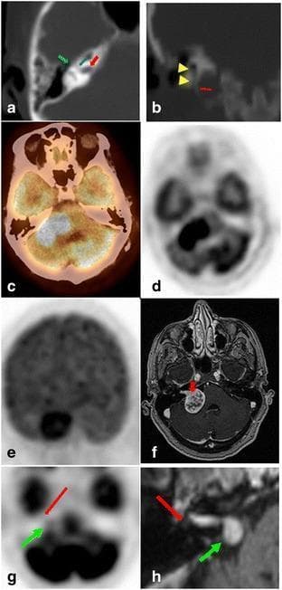 This composite educational graphic displays diagnostic imaging of the internal auditory canal (IAC) and cerebellopontine angle (CPA). Panels A and B utilize high-resolution CT to demonstrate normal temporal bone anatomy, including the facial nerve (CN VII) and vestibulocochlear nerve (CN VIII) segments. Red arrows indicate the IAC portions; blue and green arrows highlight the labyrinthine and tympanic segments of CN VII. Panel B uses the styloid process (red arrow) as a landmark for the stylomastoid foramen (yellow arrowheads). Panels C–F present a clinical case of a hypermetabolic vestibular schwannoma in the right CPA, shown on fused FDG PET/CT (C, D) and coronal MIP (E). The axial T1-weighted contrast-enhanced MRI (F) shows the characteristic 'ice cream cone' morphology of the mass extending into the IAC. Panels G and H compare FDG PET (G) and MRI (H) for a facial nerve schwannoma, characterized by tumor extension along the labyrinthine and tympanic segments of CN VII, distinguishing it from the more common vestibular nerve schwannoma.