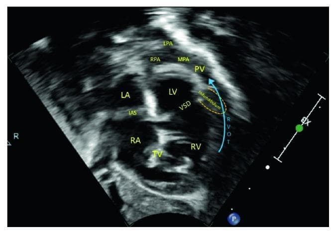 A 2D echocardiogram in the subcostal right anterior oblique plane, often referred to as the 'Tet view,' illustrating the cardinal anatomical features of Tetralogy of Fallot. The image shows a large, non-restrictive ventricular septal defect (VSD) resulting from the anterior and superior malalignment of the infundibular (conal) septum. This malalignment causes significant obstruction of the right ventricular outflow tract (RVOT), indicated by a blue directional arrow. The pulmonary vasculature, including the pulmonary valve (PV), main pulmonary artery (MPA), and the right (RPA) and left (LPA) pulmonary arteries, appears markedly hypoplastic. Key cardiac structures labeled include the right atrium (RA), left atrium (LA), tricuspid valve (TV), interatrial septum (IAS), right ventricle (RV), and left ventricle (LV). This diagnostic image demonstrates the structural basis for severe cyanotic heart disease, where infundibular stenosis and pulmonary hypoplasia severely limit pulmonary blood flow.