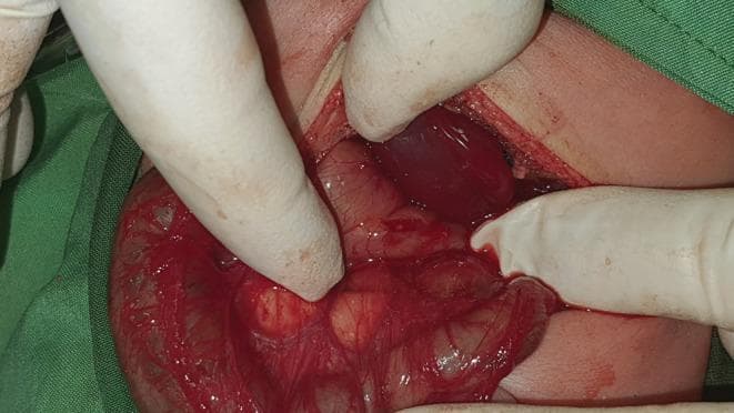 This clinical photograph captures an intraoperative view of a pediatric abdominal exploration for a Ramstedt pyloromyotomy. The surgical field, accessed via a supraumbilical incision, demonstrates the classic appearance of hypertrophic pyloric stenosis. The pylorus is visible as a thickened, olive-shaped, reddish-tan mass being manually stabilized by gloved fingers. The serosa appears glistening and hyperemic with fine superficial vasculature. Adjacent anatomical structures include the liver, which presents a dark reddish-brown color, and sections of the small intestine. In this specific case, the surgical approach is through a left-leaning incision due to situs inversus totalis, where the pylorus and liver are positioned in mirror-image to normal anatomy. The incision site shows pale skin edges with underlying subcutaneous tissue and minimal blood, surrounded by green surgical drapes. This visual highlights the surgical presentation of infant hypertrophic pyloric stenosis and its anatomical management in the context of rare congenital variations like situs inversus.