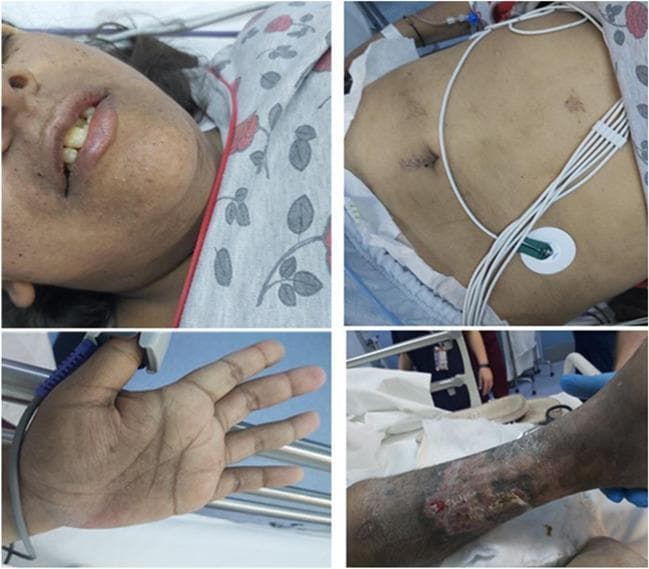 This composite of four clinical photographs illustrates classic dermatological manifestations of Primary Adrenal Insufficiency (PAI). The top-left image displays perioral and labial hyperpigmentation, with increased melanin deposition along the vermilion border. The bottom-left image highlights characteristic hyperpigmentation of the palmar creases, where skin darkening is preferentially concentrated in the flexural lines of the hand. The top-right image shows the patient's abdomen with hyperpigmented surgical scars from a recent laparoscopic cholecystectomy, demonstrating the tendency for pigmentation to accentuate at sites of trauma or friction; medical monitoring via ECG leads is also visible. The bottom-right image shows the left lower extremity featuring a chronic skin ulcer with surrounding hyperpigmentation and stasis-like changes. Collectively, these findings—generalized hyperpigmentation with accentuation in creases, scars, and mucous membranes—are hallmark signs of elevated adrenocorticotropic hormone (ACTH) levels, aiding in the clinical diagnosis of Addison's disease or adrenal crisis in a hospital setting.