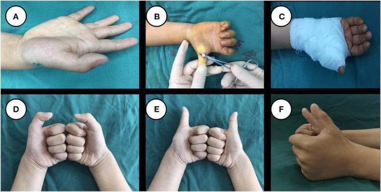 A series of six clinical photographs (A-F) documenting the surgical management and follow-up of a pediatric case of trigger thumb. Panel A shows the preoperative state with limited extension of the interphalangeal (IP) joint of the right thumb. Panel B is an intraoperative view showing the surgical A1 pulley release procedure using a small incision at the base of the thumb. Panel C illustrates immediate postoperative management with the hand immobilized in a white bandage. Panels D, E, and F provide long-term follow-up images (nearly 2 years post-surgery) demonstrating excellent functional and cosmetic outcomes. Panel D shows full flexion of the thumbs bilaterally, Panel E shows complete extension in a frontal view, and Panel F provides a lateral view of the extended thumb. These follow-up images confirm a well-healed surgical site with no visible scar formation, normal range of motion, and absence of deformity or atrophy, demonstrating successful resolution of the stenosing tenosynovitis.