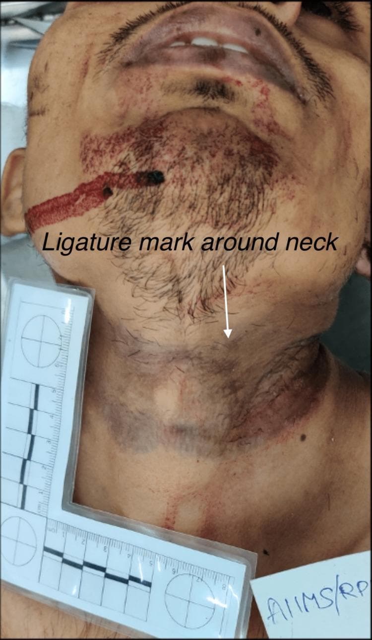 This forensic clinical photograph depicts the head and neck of a male decedent. A prominent ligature mark is visible encircling the neck, characterized as a wide, horizontal band of pressure abrasion and parchment-like skin discoloration. The mark appears more pronounced on the left anterolateral aspect of the neck, showing a reddish-brown hue consistent with vital or perimortem compression. In the facial region, a linear streak of dried blood extends obliquely across the right cheek and chin, with additional punctate blood staining noted within the beard and mustache areas. The subject's skin appears pale. A forensic L-shaped measurement scale is positioned adjacent to the left side of the neck to provide a size reference for the injuries. This image serves as a diagnostic tool in forensic pathology for documenting evidence of hanging or strangulation and associated secondary trauma in a medico-legal context.