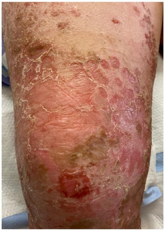 A clinical photograph displaying bullous impetigo on an extremity. The image shows the characteristic progression following the rupture of flaccid bullae. Key features include multiple superficial erosions with raw, erythematous bases, surrounded by prominent peripheral collarettes of scale representing the remnants of the blister roof. A thin, light brown (varnish-like) crust is visible in several areas, distinct from the thicker, honey-colored crust associated with non-bullous impetigo. The lesions are confluent in some regions, demonstrating the highly contagious spread of the infection within the superficial epidermis. This visual representation is an educational example of bacterial skin infection caused by Staphylococcus aureus, highlighting the diagnostic features of post-bullous erosion and scaling suitable for medical training in dermatology and pediatrics.