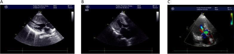 This composite diagnostic image displays three transthoracic echocardiography frames (labeled a, b, and c) from patients with familial hypertrophic cardiomyopathy (FHCM). All three grayscale B-mode images demonstrate significant asymmetric hypertrophy of the left ventricle, primarily involving the ventricular septum. Panel (a) shows a septum thickness of 2.38 cm in a 27-year-old female; panel (b) shows 2.18 cm in a 68-year-old male; and panel (c) displays a massive septal thickness of 3.36 cm in an 84-year-old female. Image (c) additionally incorporates color Doppler imaging, showing turbulent, high-velocity blood flow (manifested as mosaic blue, red, and green signals) within the left ventricular outflow tract, which is characteristic of obstructive hypertrophic cardiomyopathy. These images are clinically significant for illustrating pathognomonic structural remodeling associated with MYBPC3 gene mutations, emphasizing the role of ultrasound in measuring maximum wall thickness and assessing hemodynamic obstruction in cardiomyopathy patients.