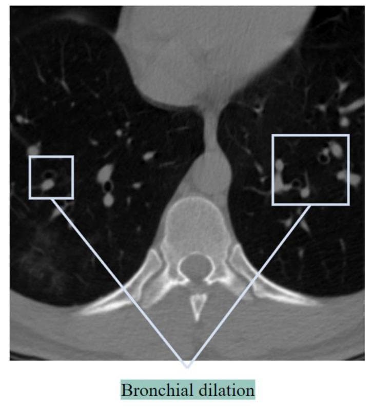 This diagnostic axial CT scan of the chest focuses on the lower lung parenchyma and mediastinal structures at the level of a vertebral body. The image primarily demonstrates the 'signet ring sign,' a hallmark radiological finding of bronchiectasis. Specifically, highlighted regions show pathological bronchial dilation where the internal diameter of the air-filled bronchus is significantly larger than its accompanying pulmonary artery. In a healthy lung, the bronchus-to-artery (BA) ratio is typically 1:1 or less; here, the enlarged, thin-walled bronchus (the ring) adjacent to the smaller, opaque circular artery (the signet) indicates airway disease. The surrounding lung parenchyma appears largely hypodense and air-filled, though multiple discrete BA pairs across both lung fields exhibit similar morphological changes. This visual is used to teach diagnostic criteria for chronic obstructive or inflammatory lung conditions, such as bronchiectasis, by illustrating the lack of normal airway tapering and disproportionate bronchial enlargement.