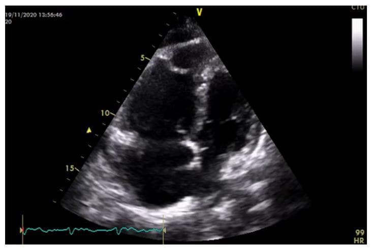 This diagnostic image is a standard transthoracic apical four-chamber view echocardiogram demonstrating advanced morphological changes secondary to pulmonary hypertension (PH). The visual focus is on the right heart structures, which exhibit significant remodeling due to chronic pressure and volume overload. Key findings include marked right ventricular (RV) hypertrophy, evidenced by thickened myocardial walls, and severe RV dilatation. The RV has lost its typical crescentic shape, appearing more spherical and globular. Furthermore, there is massive dilatation of the right atrium (RA), which appears disproportionately large compared to the left-sided chambers. These features—RV hypertrophy, spherical remodeling, and RA enlargement—are hallmark indicators of right heart failure and increased right ventricular wall stress. The image serves as an educational example of cardiac adaptation to increased pulmonary vascular resistance and chronic right heart afterload.