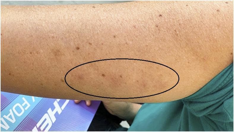 This clinical photograph shows the medial aspect of a human arm presenting with inflammatory skin lesions following insect bites. The patient has a light brown complexion with scattered benign macules (freckles or solar lentigines). Within a black oval annotation, several localized areas of pathology are visible. These findings include erythematous, slightly edematous papules that appear raised relative to the surrounding healthy tissue. The clinical presentation is consistent with a localized hypersensitivity reaction or inflammatory response to triatomine (kissing bug) bites, specifically from Triatoma sanguisuga. This image serves as a diagnostic reference for identifying the dermatological manifestations of Chagas disease vectors in North America. The key educational focus is on the morphology of arthropod-inflicted skin reactions, highlighting the characteristic redness and induration that differentiate the bite sites from general skin irregularities or normal pigmentation.