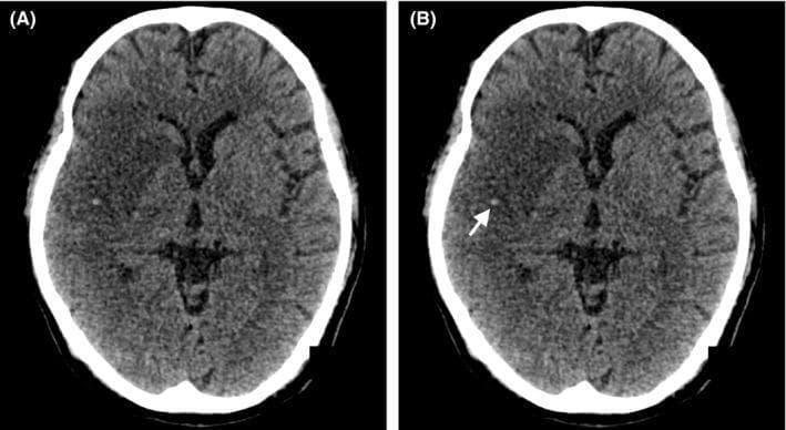 This diagnostic image displays two axial slices (A and B) of a non-contrast enhanced cranial CT scan demonstrating acute ischemic stroke. Image A reveals a large area of hypoattenuation within the right middle cerebral artery (MCA) territory, indicating an established infarct with loss of grey-white matter differentiation and subtle mass effect. In image B, a white arrow highlights the 'MCA dot sign,' characterized by a hyperdense punctate focus within the right Sylvian fissure. This radiological finding represents a thromboembolism within a distal branch of the middle cerebral artery, seen in cross-section. The images are used for medical education to teach early radiological markers of large vessel occlusion and cerebral infarction. Key concepts include identifying arterial hyperdensity (dot sign), assessing territory-specific hypodensity, and recognizing signs of cerebral edema in the context of acute neurological deficits such as hemiplegia.