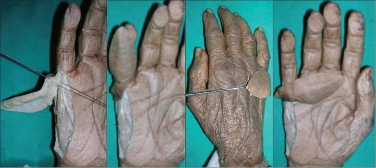 A series of four anatomical photographs from a cadaveric dissection study illustrating the ulnar artery perforator flap on a human hand. The first panel shows a longitudinal flap elevated from the ulnar border of the distal forearm and hypothenar eminence, with metal wires highlighting the underlying vascular perforators and longitudinal arcade arising from the digital artery. The second panel demonstrates the flap partially reflected, showing the subfascial tissue layer and its relationship to the fifth digit. The third panel shows a dorsal view of the hand with a metal probe indicating the arc of rotation, where the skin flap is transferred to the dorsal surface of the proximal phalanx. The fourth panel provides a palmar view of the dissected hand, emphasizing the donor site along the ulnar margin and the reach of the pedicled flap. This sequence illustrates the surgical anatomy, vascular supply, and rotational capabilities of the hypothenar ulnar artery perforator flap for reconstructive surgery of the hand.