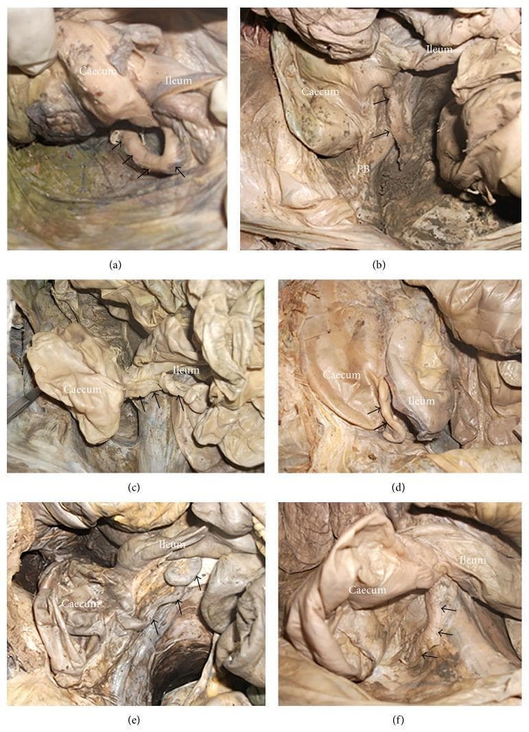 A series of six anatomical photographs (a-f) from human cadaveric dissections illustrating the various anatomical positions of the vermiform appendix relative to the cecum and terminal ileum. Each panel identifies the cecum and ileum as primary landmarks with arrows pointing to the appendix. (a) Retrocecal: the appendix is positioned posterior to the cecum. (b) Pelvic: the appendix descends over the pelvic brim (PB). (c) Preileal: the appendix is situated anterior to the terminal ileum. (d) Subileal: the appendix is located inferior or deep to the ileum. (e) Postileal: the appendix is positioned posterior to the terminal ileum. (f) Subcecal: the appendix is located inferior to the fundus of the cecum. These images provide essential clinical context for understanding surgical variations and diagnostic challenges in appendicitis and lower gastrointestinal procedures.