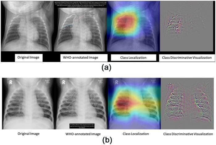 This diagnostic image comparison displays pediatric frontal chest radiographs across two cases (a and b), categorized by World Health Organization (WHO) standards for pneumonia. Each row includes the original radiograph, the WHO-annotated image, a deep learning class localization heat map, and a class discriminative visualization. Row (a) depicts Primary Endpoint Pneumonia (PEP), characterized by a dense, focal consolidation in the right upper lobe with visible air bronchograms. Despite moderate patient rotation to the right, the localized opacity remains clear. Row (b) illustrates 'other-infiltrates,' showing bilateral, diffuse, and patchy opacities that lack the well-defined density of endpoint pneumonia. These infiltrates are more dispersed throughout the lung fields rather than lobar. The visual provides a comparison between high-density lobar consolidation (PEP) and less dense, non-focal interstitial or alveolar infiltrates. This educational material is designed to train clinical recognition of diagnostic patterns in pediatric respiratory infections and demonstrates the application of artificial intelligence in localizing pulmonary pathology.