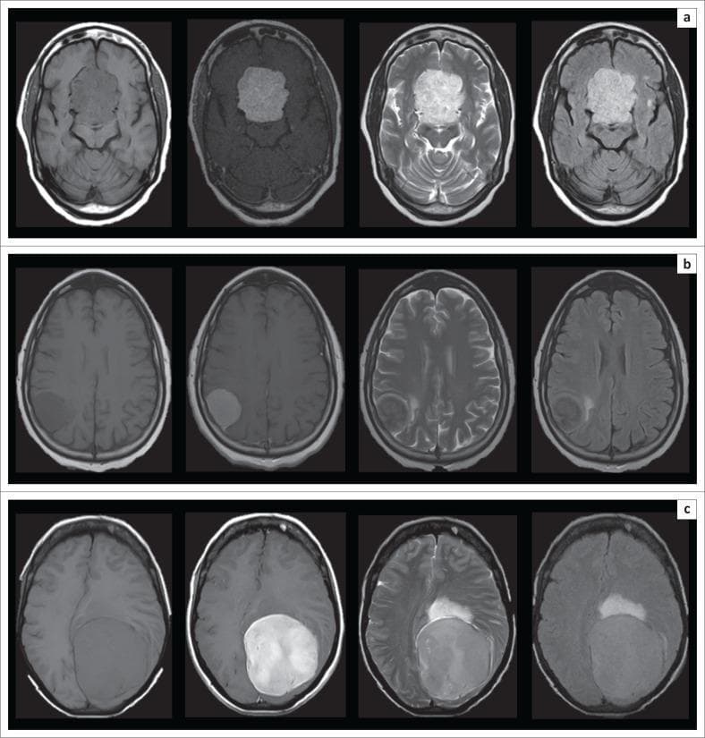 This diagnostic image set consists of three rows (a, b, c) of axial brain MRI sequences comparing WHO Grade I meningioma subtypes: meningothelial, transitional, and fibroblastic. Each row displays four standard sequences from left to right: T1-weighted imaging (T1-WI), T1-WI post-gadolinium, T2-weighted imaging (T2-WI), and Fluid Attenuation Inversion Recovery (FLAIR).