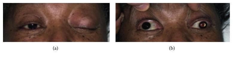 Clinical photograph in two panels (a and b) illustrating a complete left-sided third cranial nerve (oculomotor nerve) palsy. Panel (a) shows the patient attempting to open both eyes, revealing severe unilateral ptosis of the left upper eyelid, while the right eyelid remains normal. Panel (b) depicts the same patient with both upper eyelids passively retracted by an examiner. This manual elevation reveals significant anisocoria, with the left pupil demonstrating fixed mydriasis (dilation) compared to the reactive right pupil. Additionally, the left eye displays a characteristic 'down and out' gaze deviation (exotropia and hypotropia), indicating the loss of function in the superior, inferior, and medial recti, as well as the inferior oblique muscles. These visual findings are pathognomonic for a complete oculomotor nerve lesion, often associated with clinical emergencies such as pituitary apoplexy or an enlarging posterior communicating artery aneurysm.