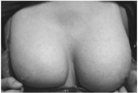 A clinical photograph of the anterior chest of a 15-year-old female patient, demonstrating bilateral Tanner stage V breast development. The image shows mature, round, and symmetrical breasts with significant volume and forward projection. The contour is smooth and continuous, indicating full development of the glandular and fatty tissue, consistent with late puberty. The skin appears uniform in texture without visible lesions, striae, or masses. This visual is significant for pediatric and adolescent medicine when assessing pubertal progression and secondary sexual characteristics. In the clinical context of primary amenorrhea, as noted in the metadata, such normal breast development (Tanner stage V) despite a 46,XY karyotype is a characteristic clinical finding in Swyer syndrome (pure gonadal dysgenesis), where the phenotype is typically female despite the chromosomal genotype.