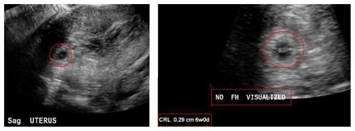 This diagnostic imaging set consists of two grayscale obstetric ultrasound views of the uterus in the sagittal plane. The left image shows a wide sagittal view of the uterus containing a small, circular, hypoechoic gestational sac (circled in red). An adjacent area of mixed echogenicity and heterogeneity is visible, consistent with a subchorionic hemorrhage. The right image provides a magnified view of the intrauterine gestational sac with electronic calipers measuring a fetal pole. The Crown-Rump Length (CRL) is noted as 0.29 cm, corresponding to a gestational age of 6 weeks and 0 days. An annotation 'NO FH VISUALIZED' confirms the absence of detectable fetal cardiac activity. These findings illustrate the clinical presentation of an early intrauterine pregnancy with complications including subchorionic hematoma and absence of fetal heart rate, which are significant for assessing pregnancy viability and diagnosing potential early pregnancy loss.