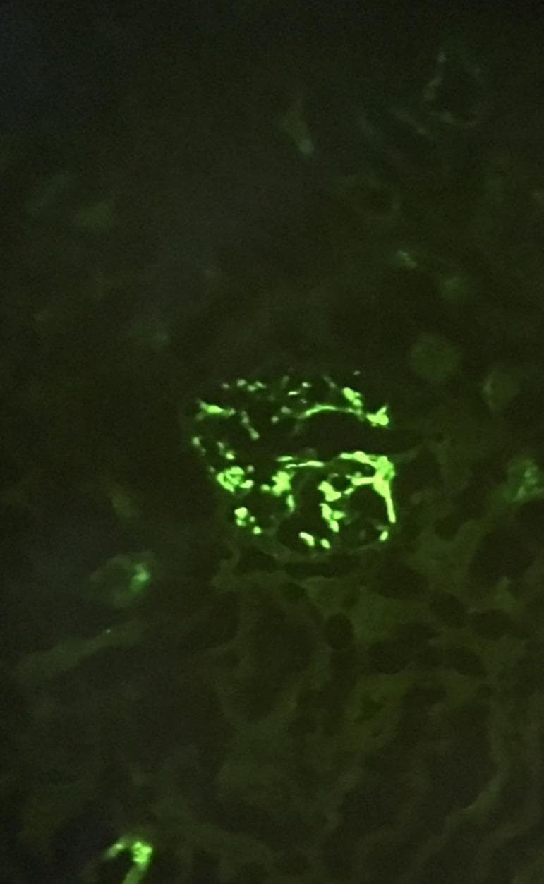 This diagnostic image shows a renal biopsy specimen analyzed via direct immunofluorescence (DIF). The central feature is a glomerulus exhibiting intense, bright green fluorescence against a dark background. The fluorescence displays a characteristic granular pattern, localized predominantly within the mesangium (mesangial distribution). These granular deposits are irregular in size and shape, effectively outlining the branching structures of the glomerular tuft. This specific immunopathological finding is diagnostic for IgA nephropathy, representing the deposition of IgA-containing immune complexes in the renal mesangial areas. The surrounding renal parenchyma shows minimal non-specific background fluorescence. This visual is representative of Haas class III IgA nephropathy, typically associated with hematuria and significant proteinuria.