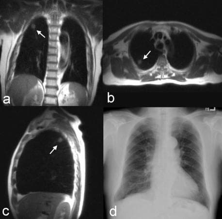 This diagnostic imaging set compares thoracic MRI and radiography findings for a solitary pulmonary nodule. Panels (a), (b), and (c) present MRI T2-weighted HASTE (Half-Fourier Acquisition Single-Shot Turbo Spin Echo) images in coronal, axial, and sagittal planes, respectively. These MRI scans utilize a 'black blood' preparation technique, which suppresses vascular signals to highlight parenchymal abnormalities. A consolidated, irregular mass approximately 1.2 cm in diameter is clearly visible (white arrows) within the posterior segment of the right upper lobe. The lesion appears hyperintense against the signal-void background of the aerated lung. Panel (d) shows a corresponding posterior-anterior (PA) chest radiograph where the lesion is not readily identifiable, demonstrating the higher sensitivity of specific MRI sequences over conventional X-ray for small peripheral lesions. Clinically, this image set illustrates the detection of Stage Ia squamous cell carcinoma. The case highlights the educational utility of multi-planar MRI reconstruction in oncological staging and the diagnostic limitations of standard radiography in early-stage lung cancer detection.