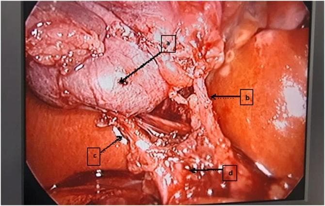 This laparoscopic clinical photograph illustrates the intraoperative identification of the 'Critical View of Safety' (CVS) during a cholecystectomy. The image shows the hepatobiliary anatomy after meticulous dissection and the release of an incarcerated Hartmann pouch from Calot's triangle. Four key structures are labeled: (a) the fundus and body of the gallbladder, demonstrating cephalad retraction; (b) the cystic artery, clearly isolated and originating from the right hepatic artery; (c) the cystic duct, seen entering the gallbladder neck; and (d) the common hepatic duct, which forms the medial boundary of the triangle. The image demonstrates the clinical application of surgical techniques to prevent bile duct injury by ensuring only two structures (the cystic duct and cystic artery) enter the gallbladder and that the lower third of the gallbladder is separated from the liver bed (cystic plate). This photograph serves as an educational resource for general surgery residents studying biliary anatomy and laparoscopic safe-entry protocols.