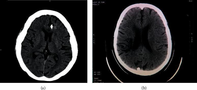 This diagnostic image shows a side-by-side comparison of axial non-contrast Computed Tomography (CT) scans of the brain. Image (a) depicts a patient diagnosed with a Primitive Neuroectodermal Tumor (PNET), demonstrating a focal, hyperdense (bright white) lesion in the right frontal lobe near the midline. This hyperdensity may represent calcification or acute hemorrhage within the tumor mass, common features in PNET pathology. Image (b) shows a healthy control with normal intracranial density and symmetrical structures. In both scans, the bony calvarium appears intact and the ventricular system is visible. The PNET scan (a) shows slightly less distinct cortical sulci in the region surrounding the hyperdense lesion, potentially suggesting mild localized vasogenic edema or mass effect. This comparison serves as an educational tool for neuroradiology to identify abnormal intracranial densities and recognize the radiographic presentation of pediatric or adult neuroectodermal malignancies.