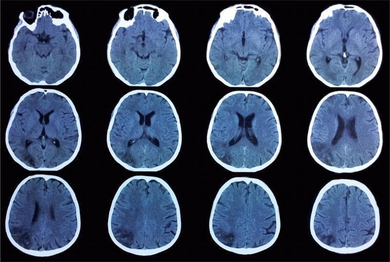 This diagnostic image is a non-contrast axial CT scan of the brain, presented in a 12-slice grid arrangement from superior to inferior. The imaging demonstrates multifocal subacute ischemic findings primarily localized to the right hemisphere. Key pathological features include well-defined areas of hypoattenuation (low density) in the right middle cerebral artery (MCA)–posterior cerebral artery (PCA) watershed territory, visible in the middle and lower rows. Additionally, there are hypodense lesions in the right anterior cerebral artery (ACA) territory and a subtle lacunar infarct in the right thalamus. Anatomical landmarks such as the lateral and third ventricles, basal ganglia, and cortical sulci are visualized. The midline remains stable without significant mass effect or shift, despite the established areas of infarction. This CT series illustrates the characteristic visual presentation of territorial and watershed strokes in a clinical neurology context, highlighting the importance of vascular territory recognition in neuroradiology.