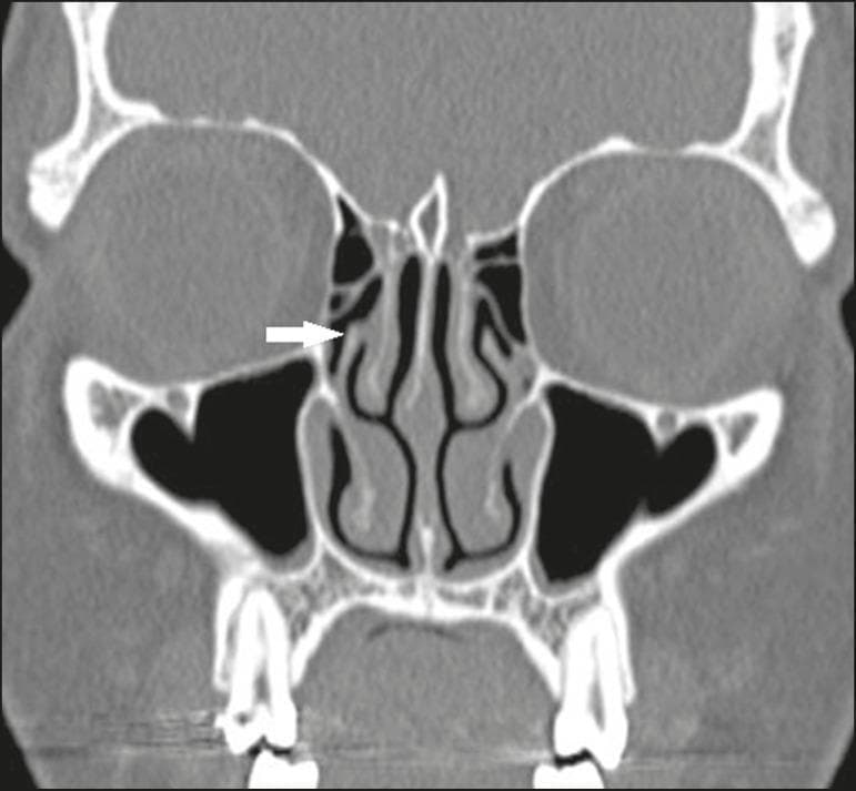 This diagnostic image is a coronal CT scan of the paranasal sinuses using bone window settings, highlighting the complex anatomy of the sinonasal cavities. The focus is on the right osteomeatal complex, where a white arrow points to a Landsberg and Friedman type 6 anatomical variation: the superior portion of the right uncinate process inserts directly into the medial surface of the middle turbinate. Surrounding structures clearly visible in high contrast include the nasal septum, bilateral middle and inferior turbinates, ethmoid air cells, and the air-filled maxillary sinuses. The orbits and orbital floors are visualized superior to the maxillary sinuses, and the frontal sinuses are seen at the top of the frame. This educational visual is critical for otorhinolaryngologists and radiologists to identify anatomical variants of the uncinate process, which determines the drainage pathway of the frontal recess and influences surgical planning for functional endoscopic sinus surgery (FESS).