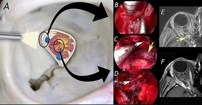 This composite educational image illustrates a transorbital endoscopic-assisted surgical approach for the resection of an orbital apex cavernous hemangioma. Panel A provides a schematic diagram of the orbital apex anatomy, detailing neurovascular structures including the optic nerve, oculomotor nerve branches, and the ophthalmic artery. Panels B, C, and D are intraoperative endoscopic photographs capturing key surgical steps: (B) exposure of the lateral aspect of the superior orbital fissure (indicated by asterisks), (C) identification of the cavernous hemangioma (yellow arrow), and (D) microsurgical dissection of the lesion from the superior division of the oculomotor nerve (white arrow) and the ophthalmic artery (red arrow). Panels E and F present axial T1-weighted MRI scans for comparison: (E) shows the preoperative state with a well-defined mass in the orbital apex compressing adjacent structures, while (F) demonstrates the postoperative result with complete lesion resection and restoration of the orbital apex space. The material is intended for neurosurgical and ophthalmological education, focusing on minimally invasive skull base techniques.