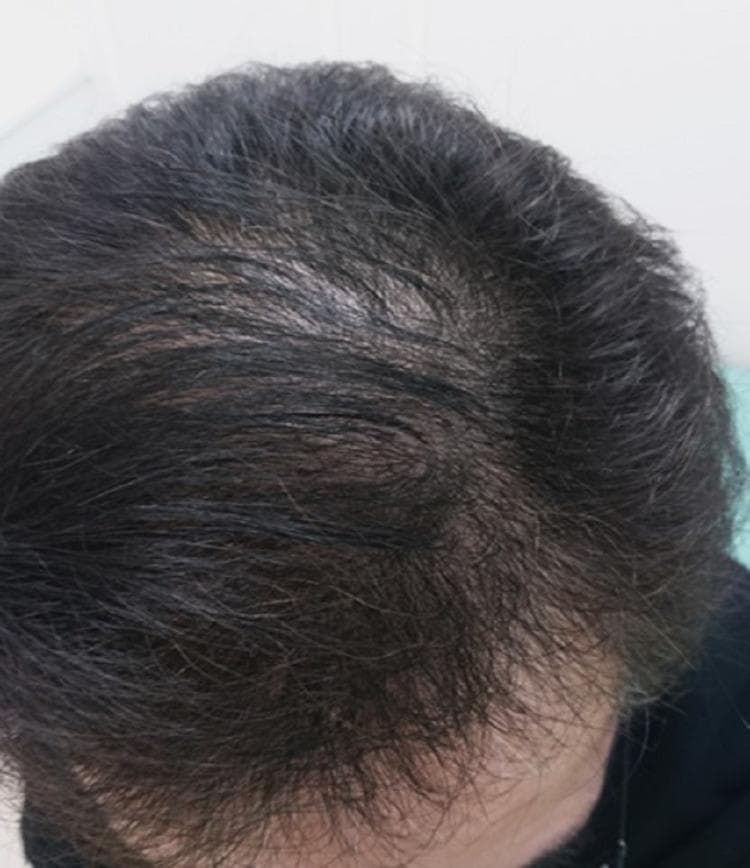 This clinical photograph provides a superior view of the human scalp, demonstrating the clinical presentation of telogen effluvium during the recovery phase. The patient exhibits dark, terminal hair coverage across the majority of the scalp. While hair density has significantly improved, visible thinning remains prominent at the vertex and mid-scalp regions, where the underlying scalp skin is partially visible through the hair shafts. This diffuse thinning pattern is characteristic of systemic stress-induced hair loss, such as that following severe viral infection or hospitalization. The image illustrates the gradual process of hair follicle re-entry into the anagen phase, showing substantial regrowth and volume restoration compared to acute stages of alopecia. This visual is an important educational resource for dermatology and internal medicine, highlighting the natural history and favorable prognosis of post-inflammatory telogen effluvium.